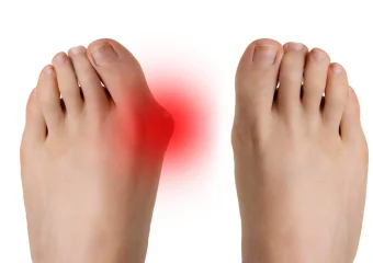 Imagen comparativa de un pie con juanetes (hallux valgus) y un pie sano, mostrando la deformidad y su impacto en la salud del pie.