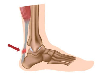 Ilustración del tendón de Aquiles con inflamación y área de dolor marcada.