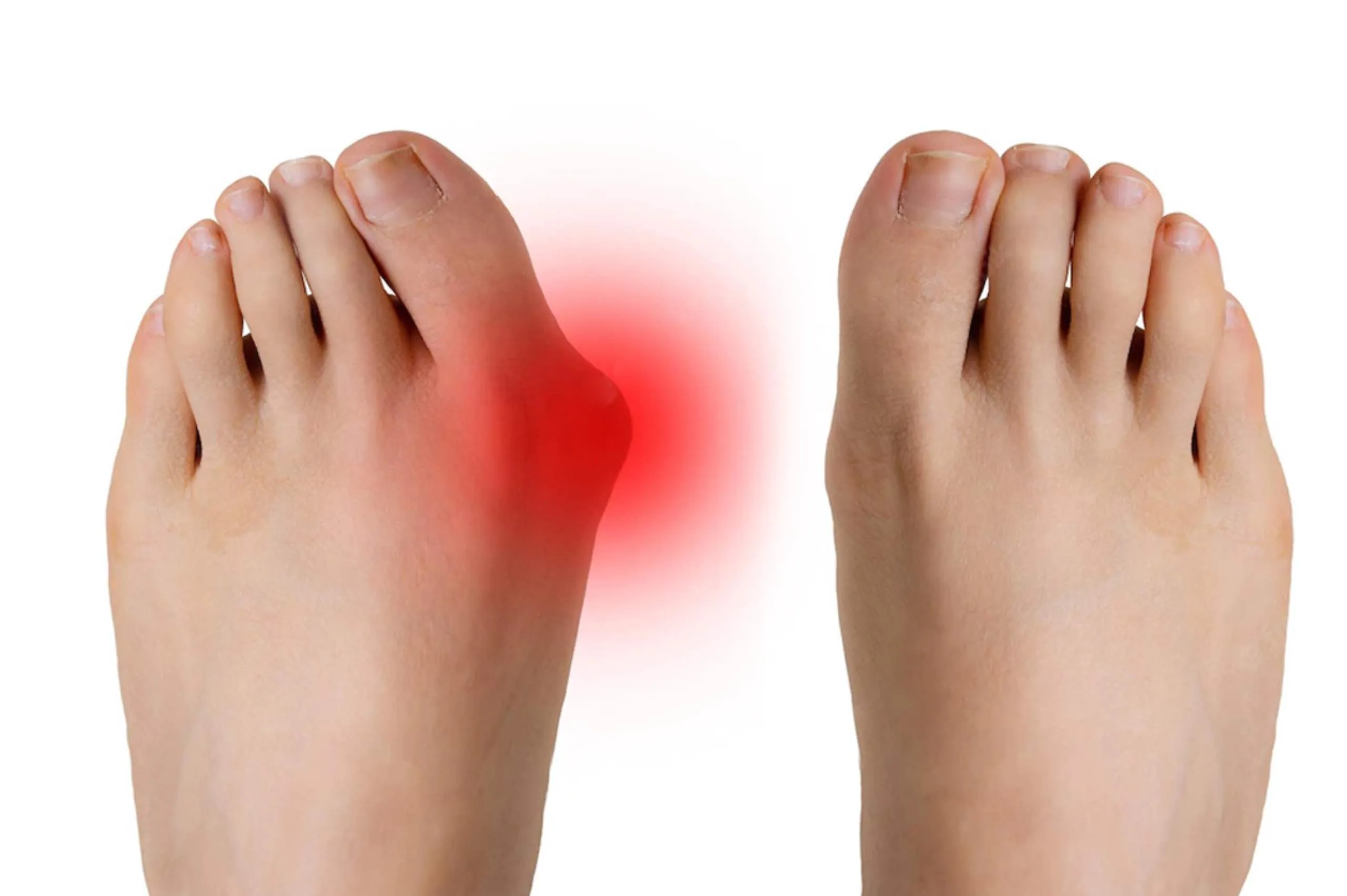 Imagen comparativa de un pie con juanetes (hallux valgus) y un pie sano, mostrando la deformidad y su impacto en la salud del pie.